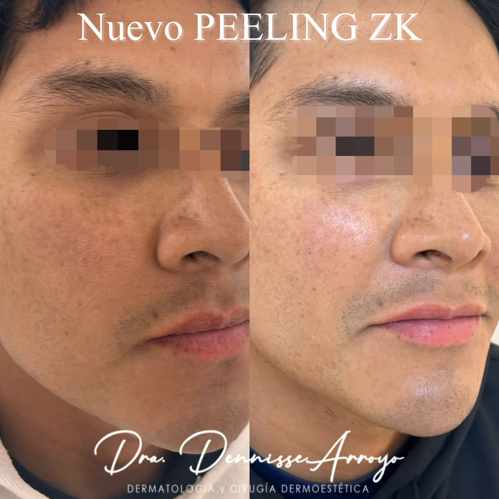  - Después